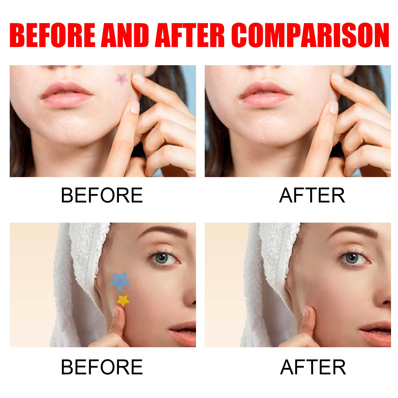 Cute Star Hydrocolloid Acne Pimple Patches